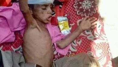 صورة بالصور #جريمة بشعة.. حبس وتعذيب طفل 4 أشهر من قبل والده في #تعز اليمنية