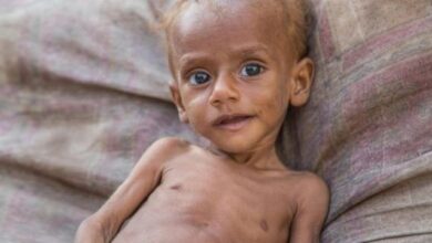 صورة “الصحة العالمية”: 75% من أطفال اليمن يعانون من سوء التغذية المزمن