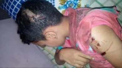 صورة تحذيرات من تفشي داء الكلب في صنعاء