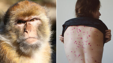 صورة نفت وجود إصابات.. وزارة الصحة تستنفر أطقمها الطبية لمواجهة جدري القرود