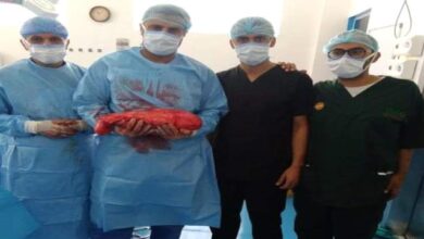 صورة شبوة.. استئصال ورم يزن 3.5كجم من مريض بمستشفى عتق العام