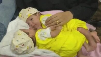 صورة بدء عملية فصل التوأم السيامي “مودة ورحمة” بمستشفى الملك عبدالله  في الرياض