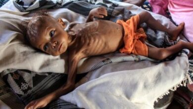 صورة سوء التغذية.. الغول المتوحش الذي صنعته الحرب الحوثية